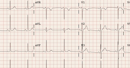 Electrocardiograma en Guayaquil